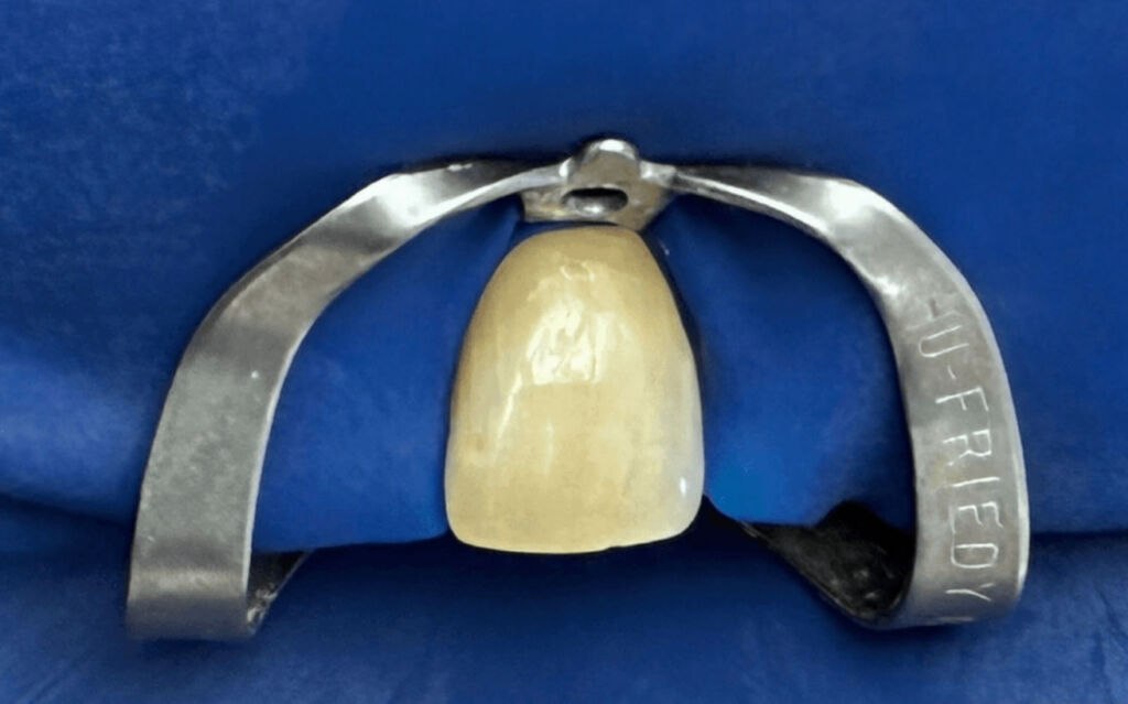 sbiancamento interno